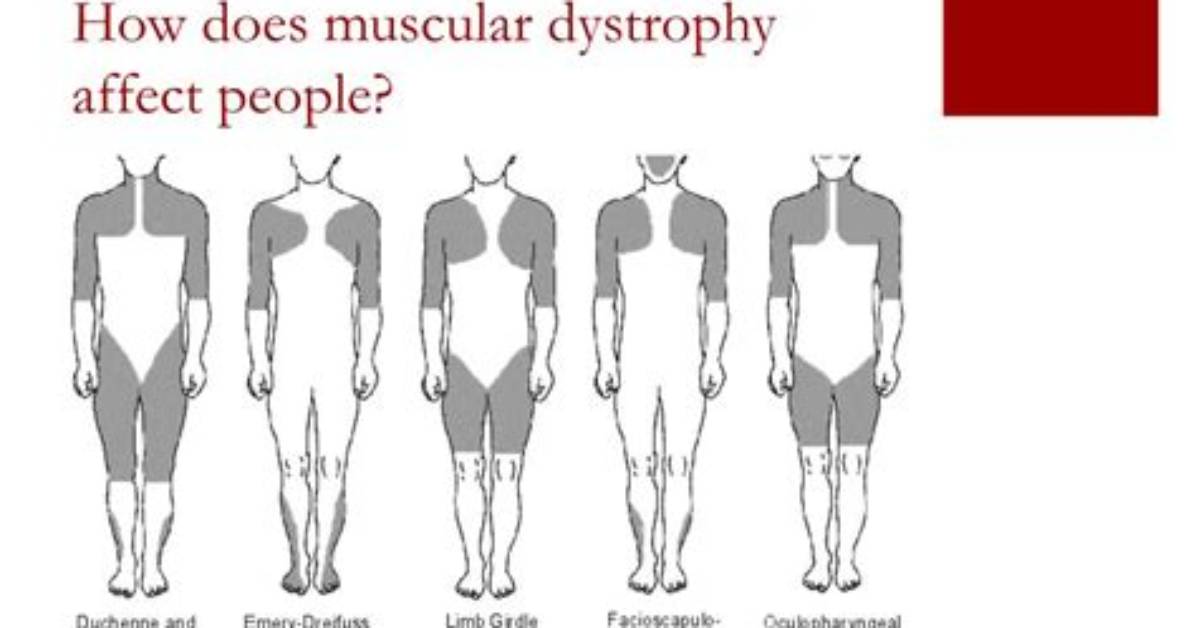 How Does Muscular Dystrophy Affect a Person?