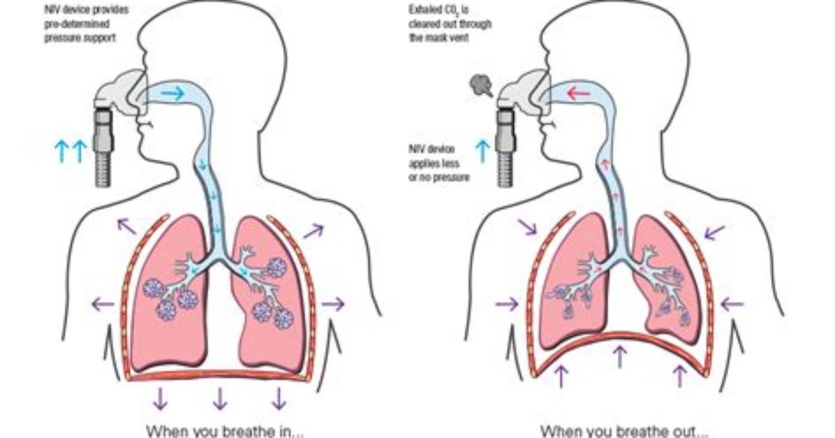 How Does Niv Work in Copd