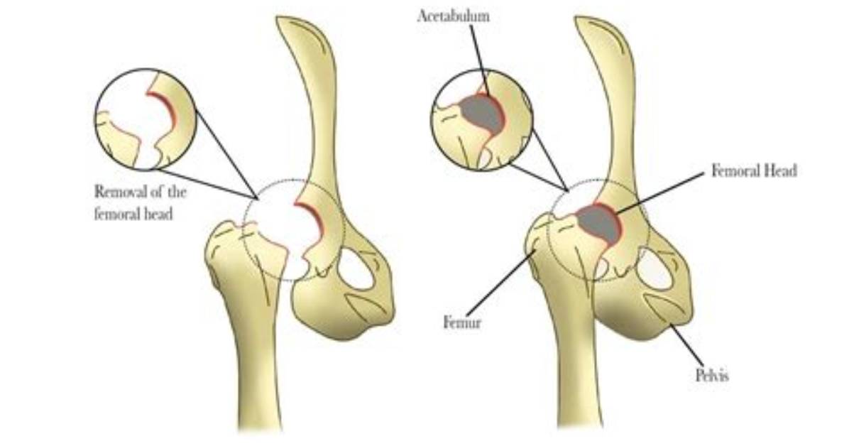 How Does Ostectomy Work?