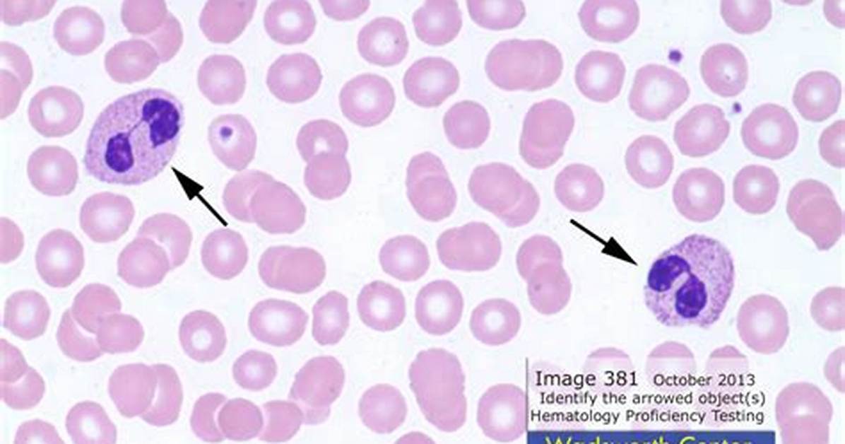 How Does Pelger Huet Anomaly Affect the Body