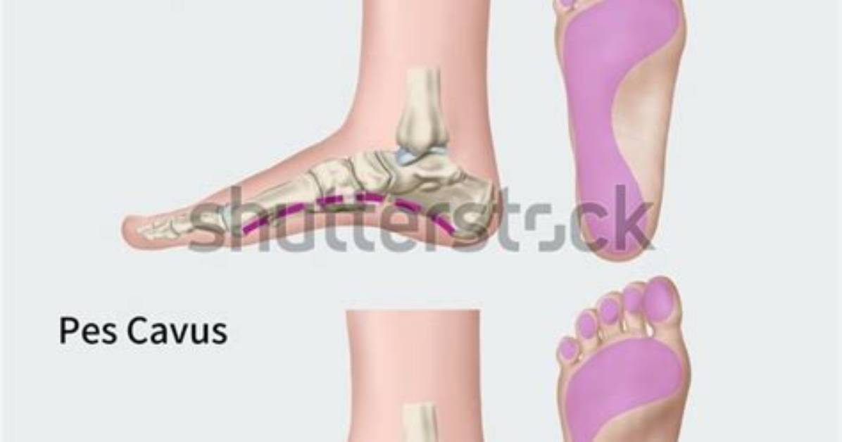 How Does Pes Cavus Happen