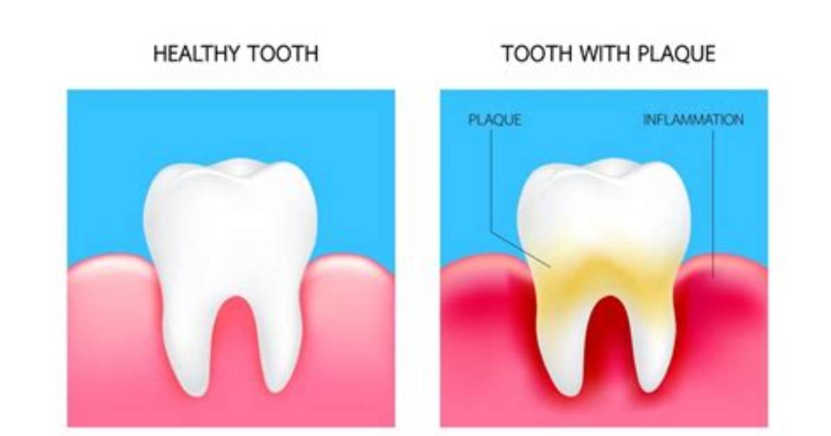 How Does Plaque Look Like?