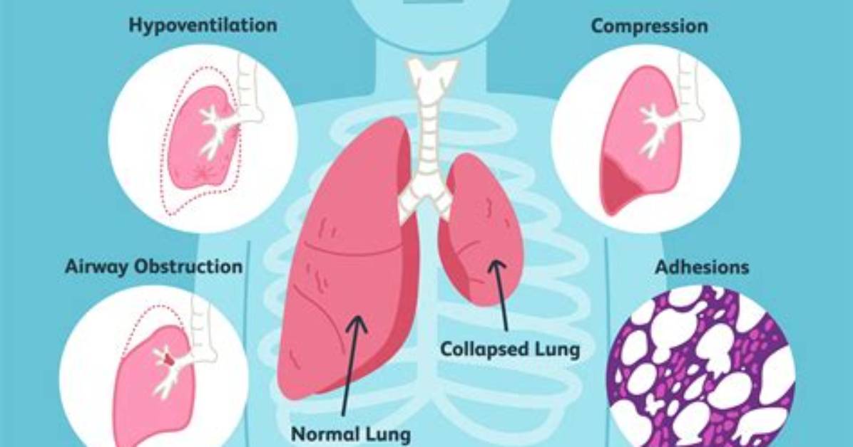 How Does Pulmonary Embolism Cause Atelectasis