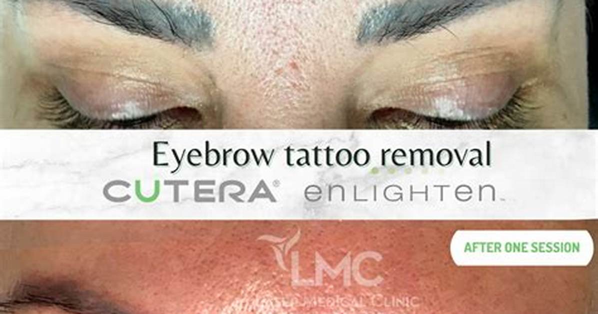 How Does Salt Remove Eyebrow Tattoo?