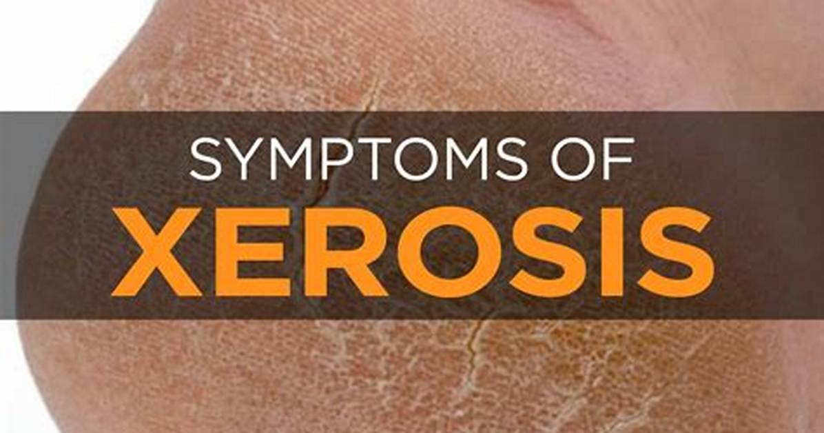 How Does Xerosis Look?