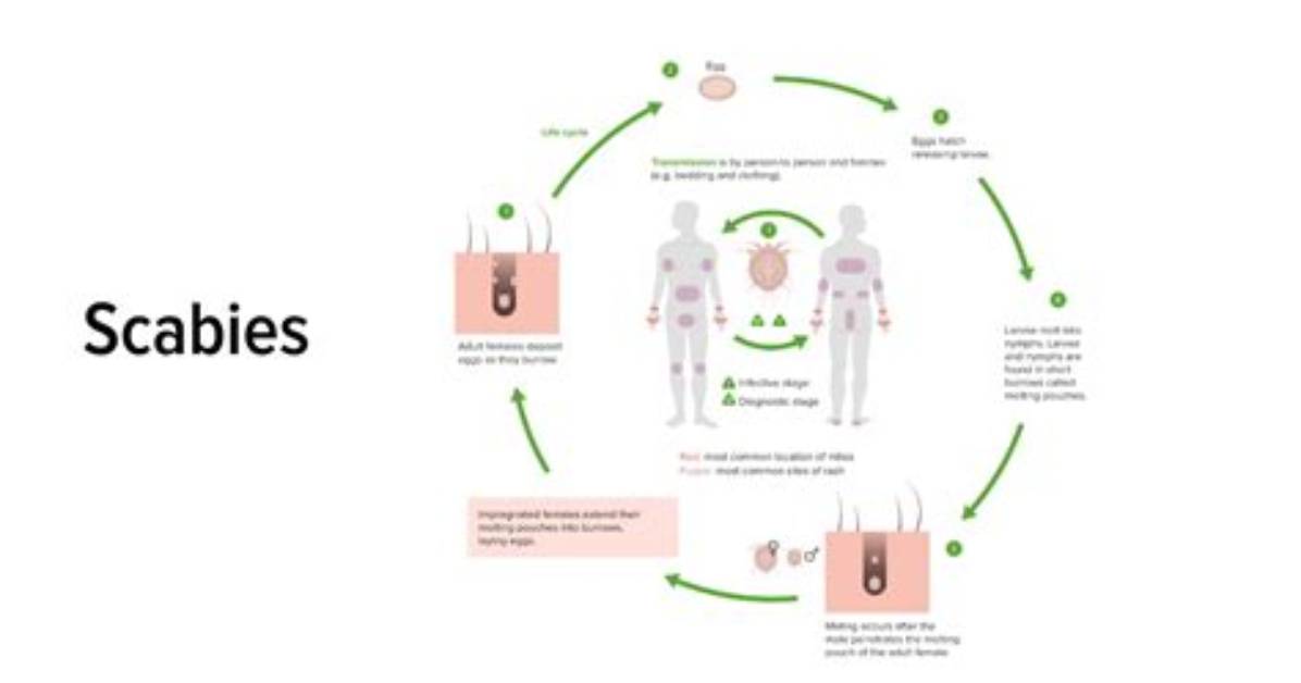How Easily Is Scabies Spread