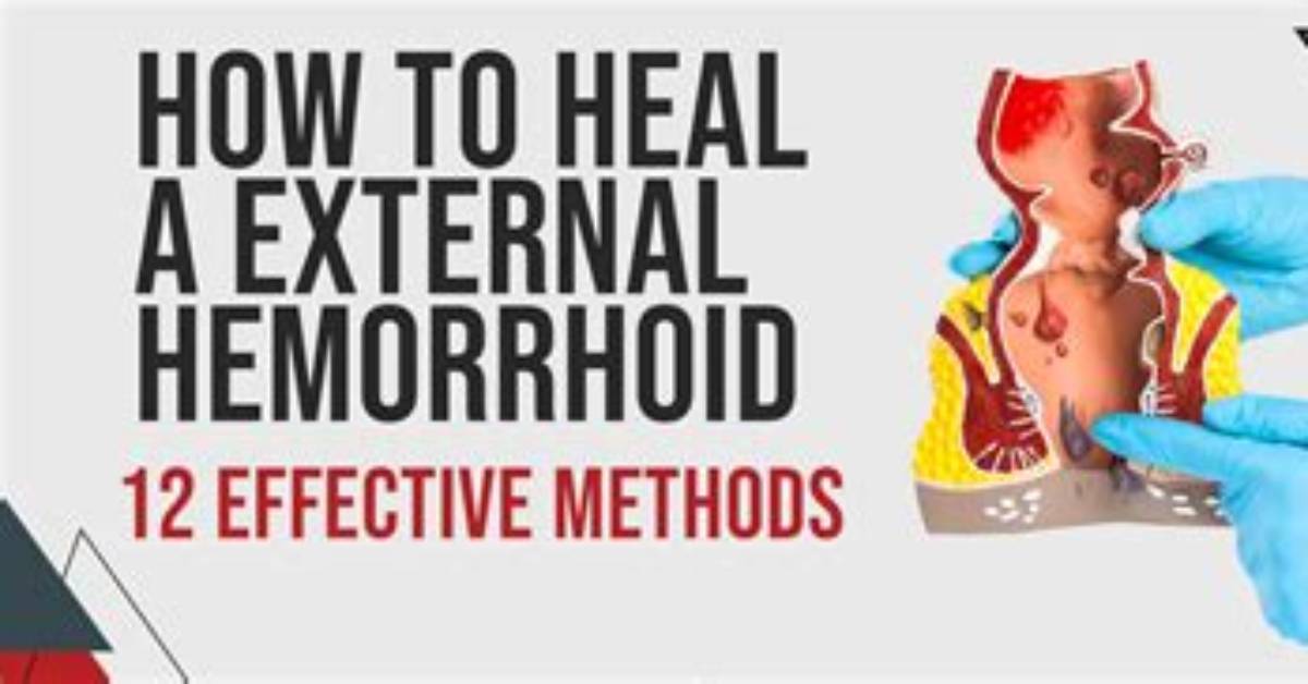How External Hemorrhoids Heal?