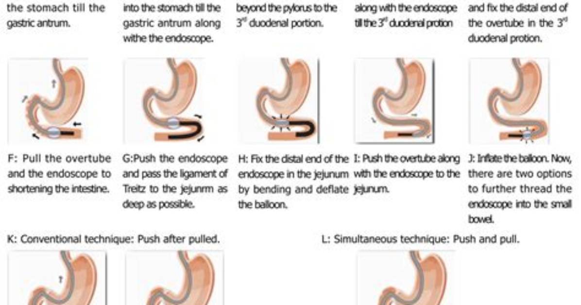 How Far Does Push Enteroscopy Go?