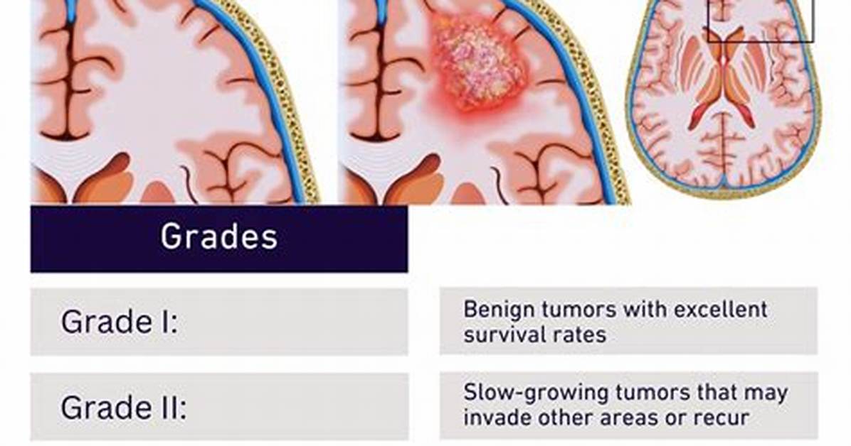 How Fast Do Brain Tumors Grow?