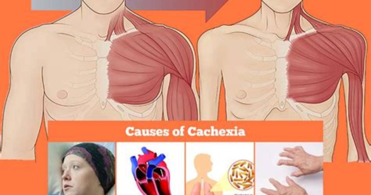 How Fast Does Cachexia Progress?