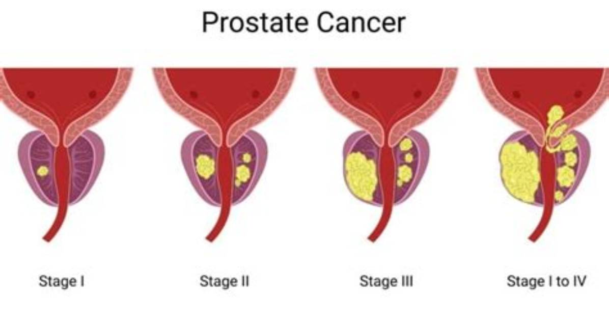 How Fast Does Prostate Cancer Progress?