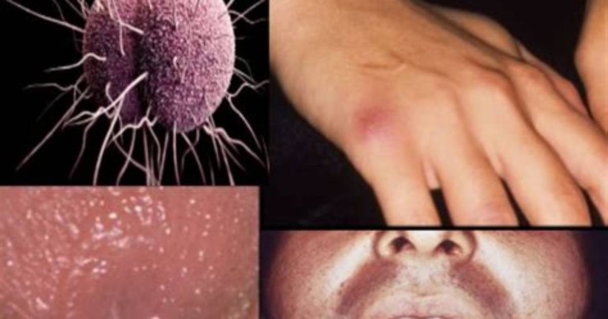 How Gonorrhea Is Caused?