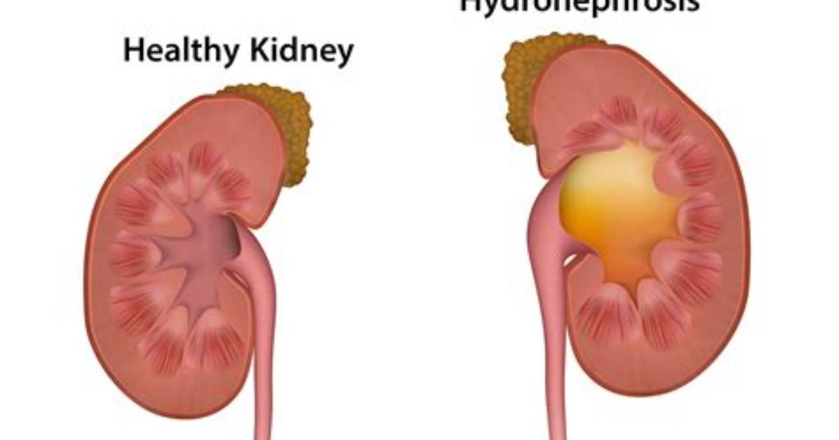 How Hydronephrosis Affect Kidney Function?