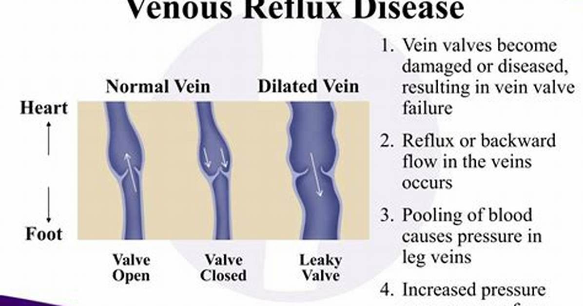 How Is a Venous Reflux Study Done