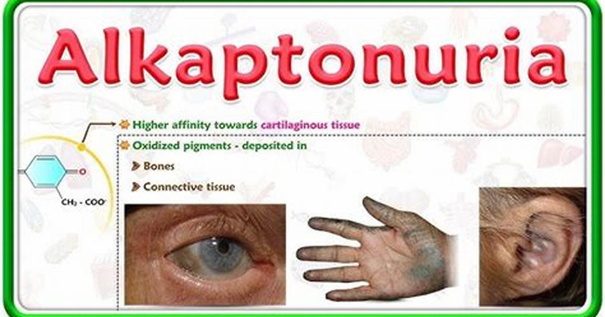How Is Alkaptonuria Transmitted?