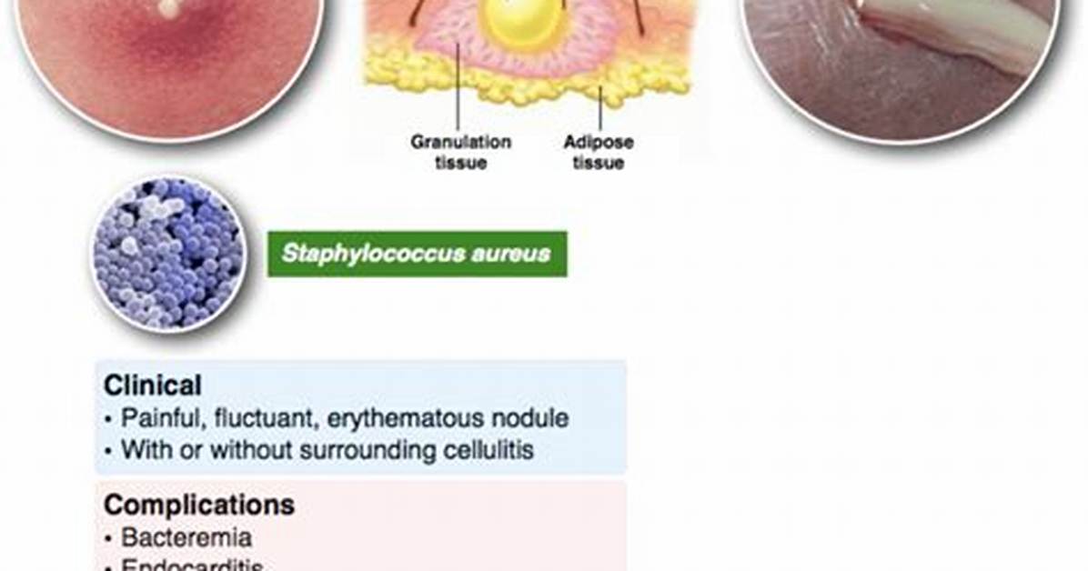 How Is an Abscess Formed?