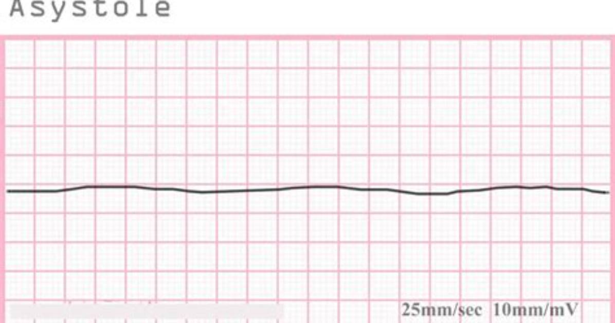 How Is Asystole Treated?