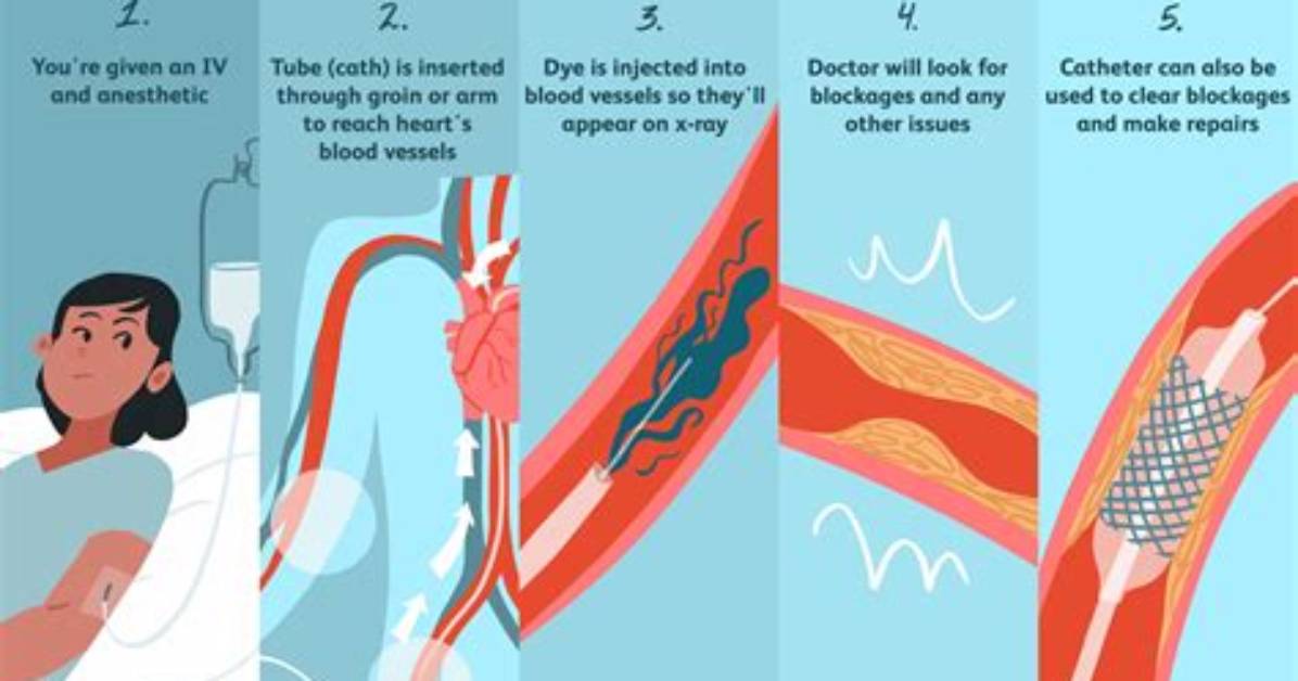 How Is Catheterization Performed?