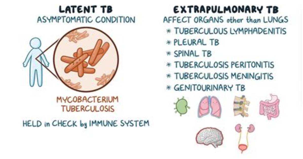 How Is Extrapulmonary Tuberculosis Spread?