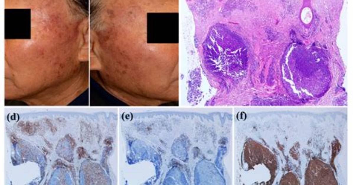 How Is Lymphoid Hyperplasia Treated?