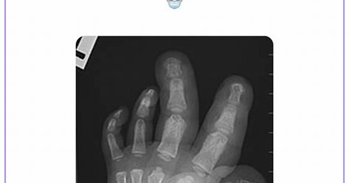 How Is Macrodactyly Diagnosed?