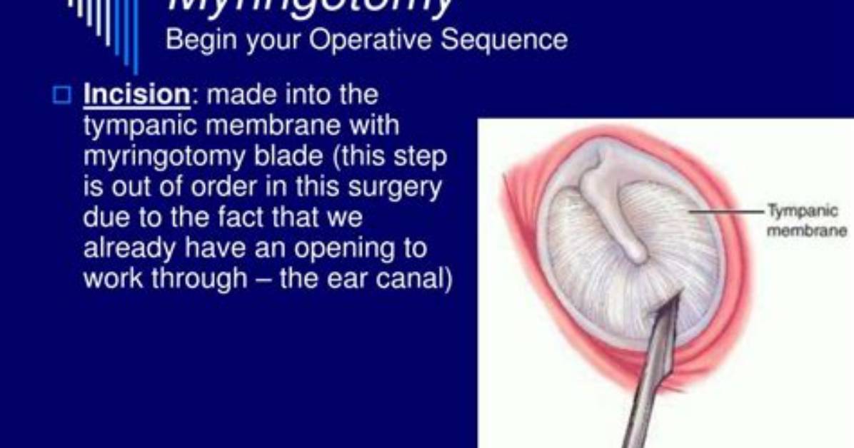 How Is Myringotomy Performed?