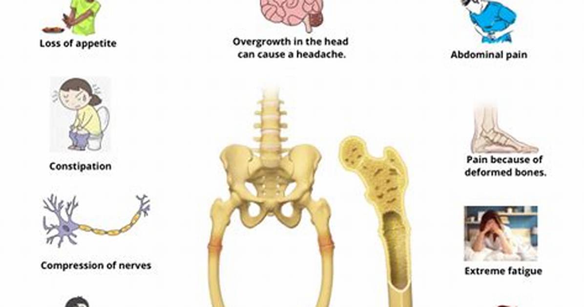How Is Pagets Disease Prevented