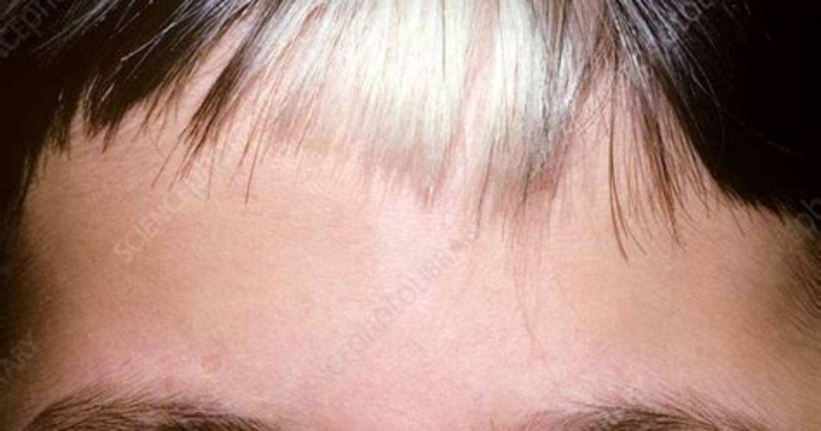 How Is Piebaldism Caused?