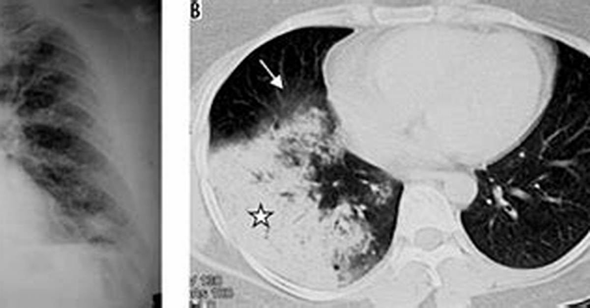 How Is Pna Diagnosed