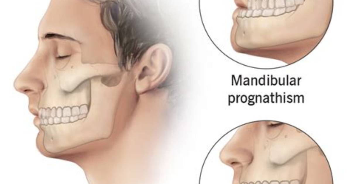How Is Prognathism Treated