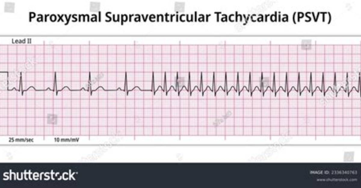 How Is Psvt Diagnosed