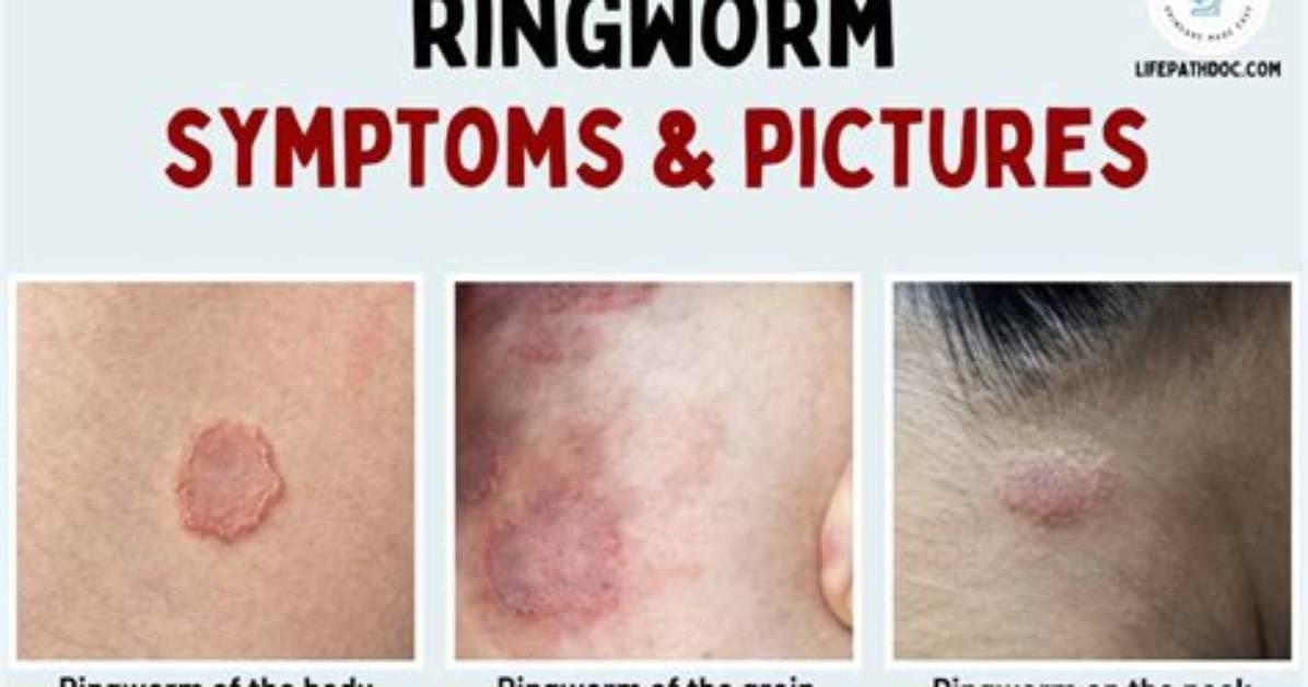 How Is Ringworm Caused?
