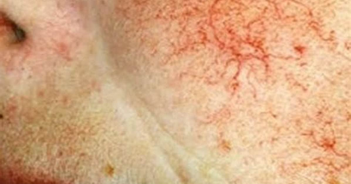 How Is Telangiectasia Prevented?