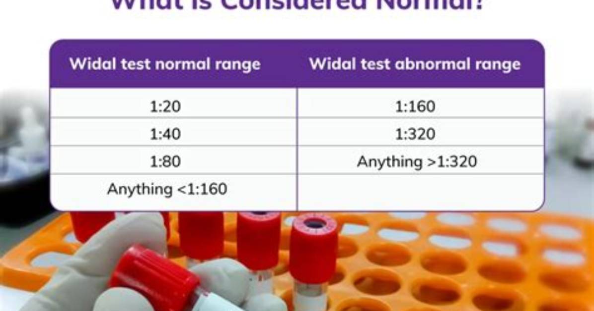How Is Widal Tested? | Contextresponse. Com