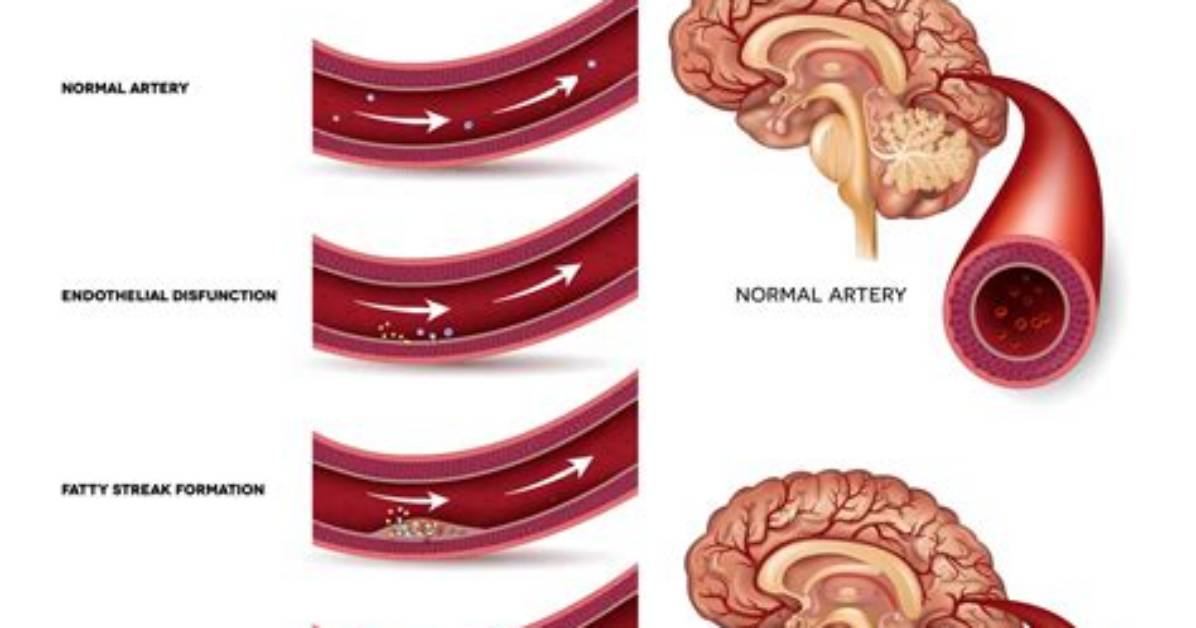 How Ischemic Stroke Occurs?