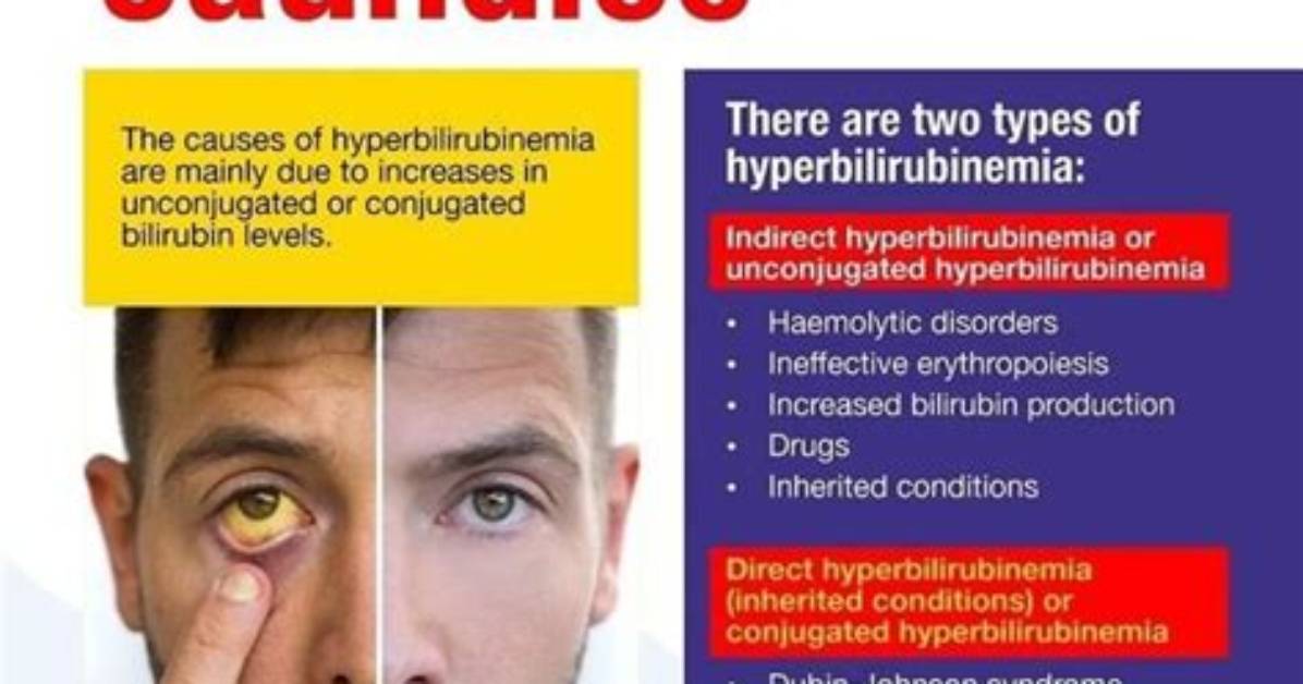 How Jaundice Can Be Cured?