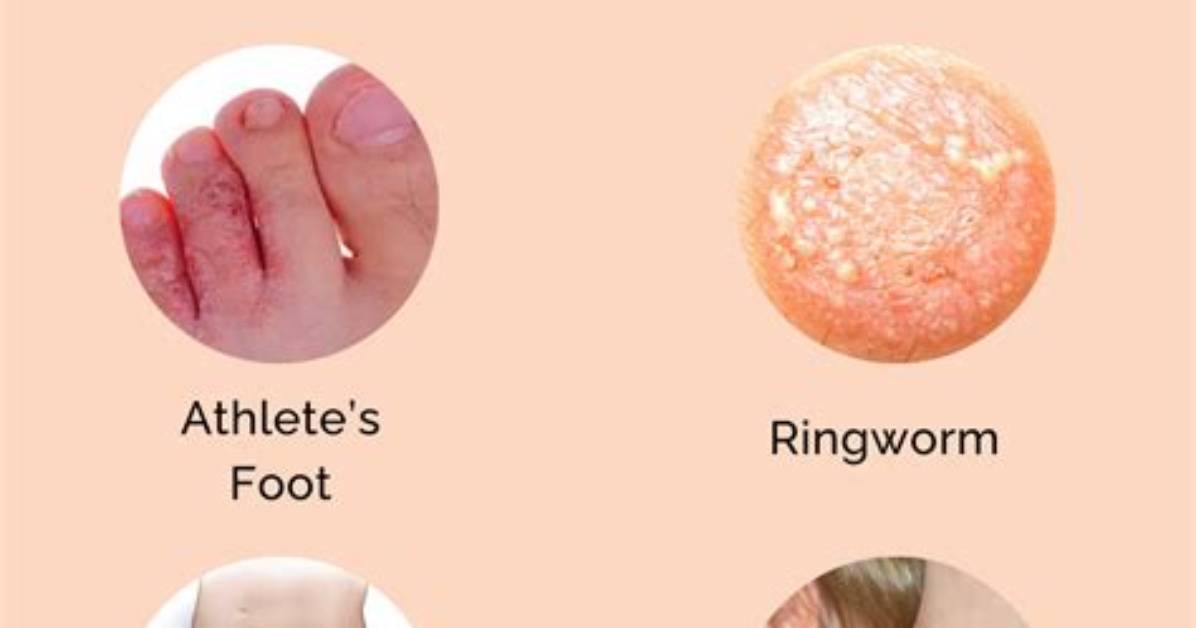 How Long Can a Fungal Infection Last Untreated?