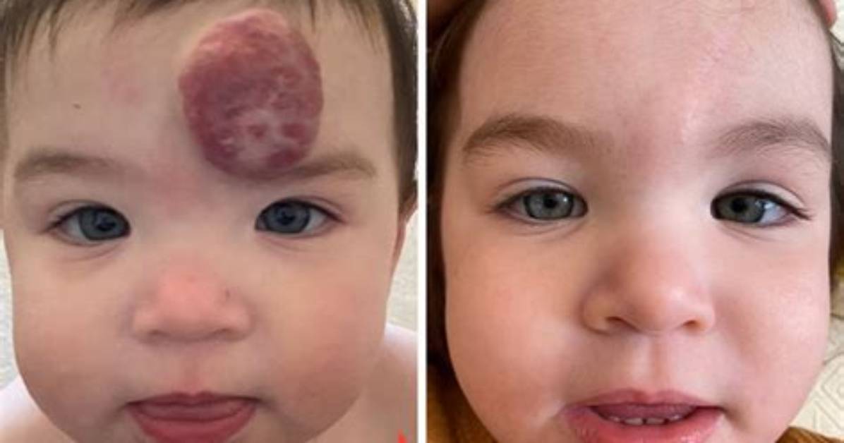 How Long Do Hemangiomas Last?