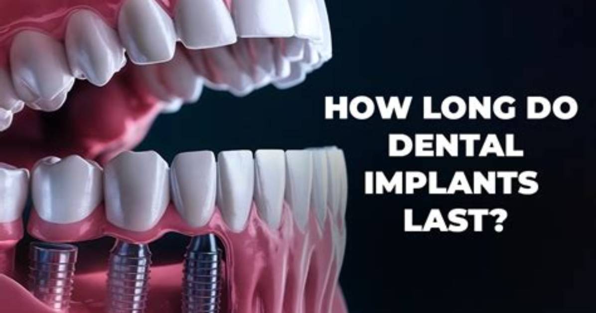 How Long Do Implants Last?