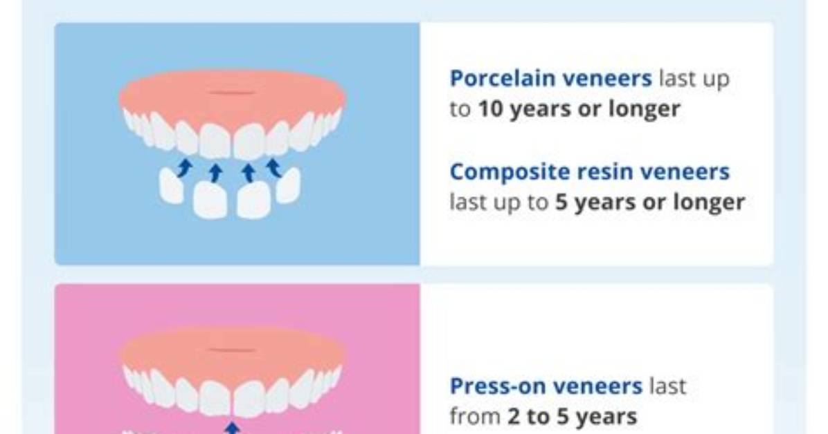 How Long Do Teeth Veneers Last?