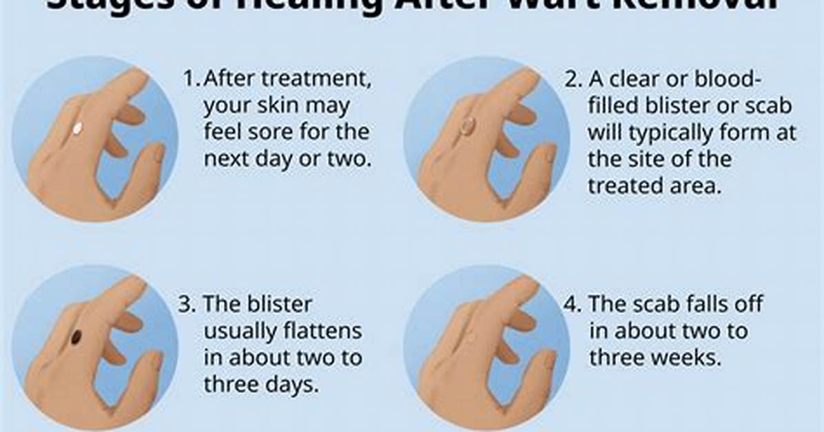 How Long Do Warts Last?