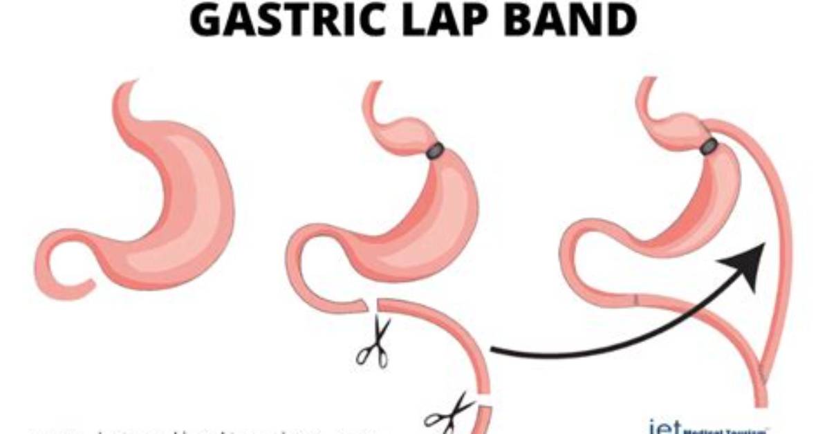 How Long Does a Lap Band Last