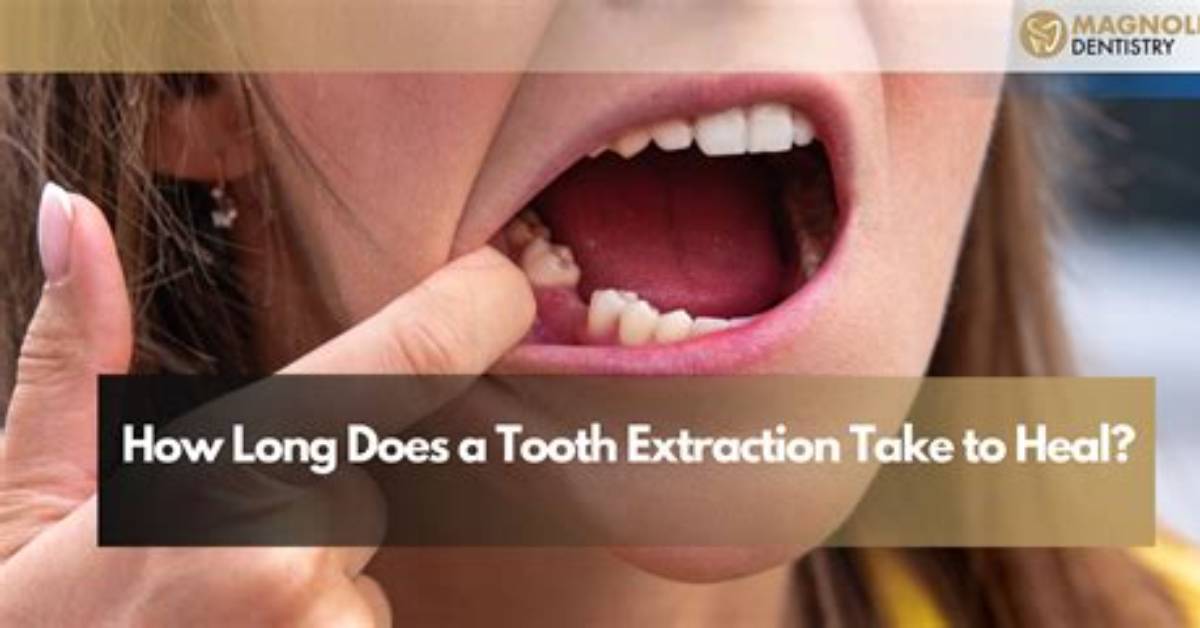 How Long Does a Tooth Extraction Take?