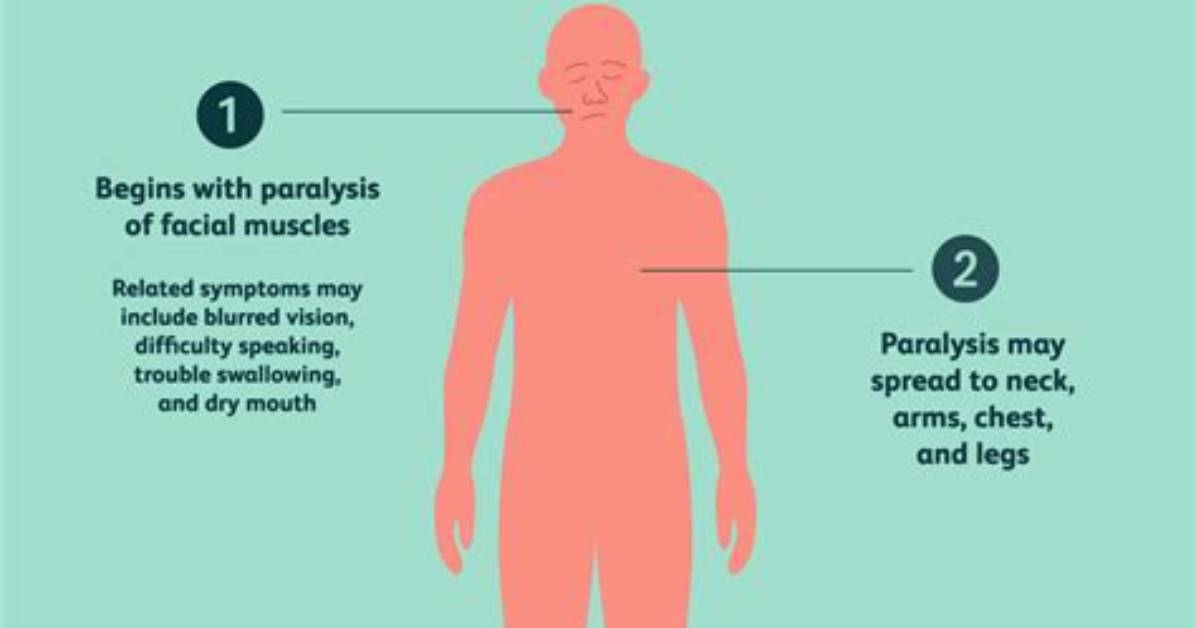How Long Does Botulism Last