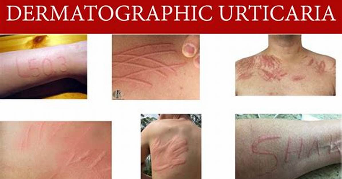 How Long Does Dermatographic Urticaria Last?