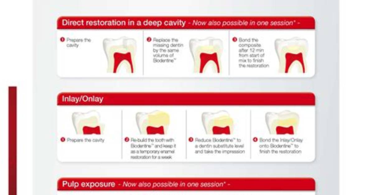 How Long Does It Take for Biodentine to Set?
