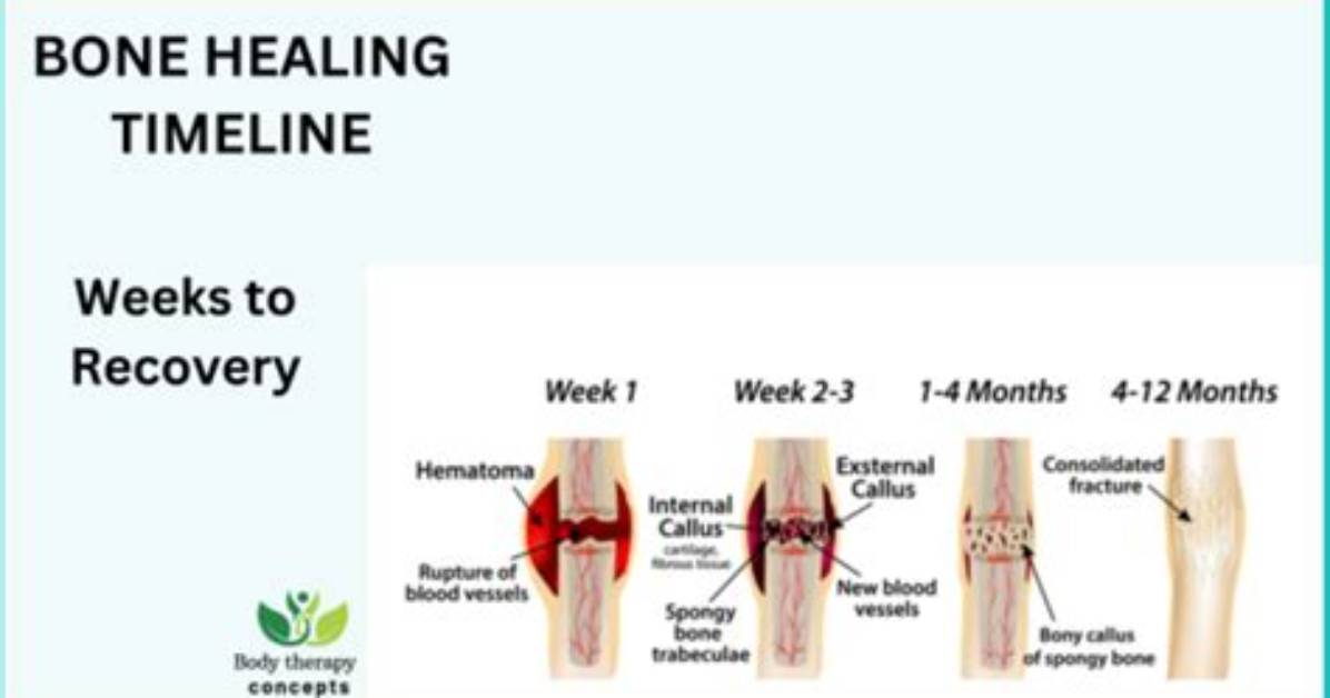 How Long Does It Take for Bone to Grow into Hip Replacement?
