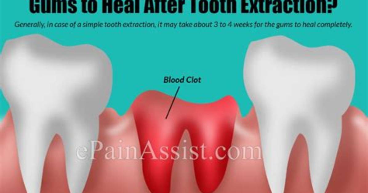 How Long Does It Take for Gums to Recede?