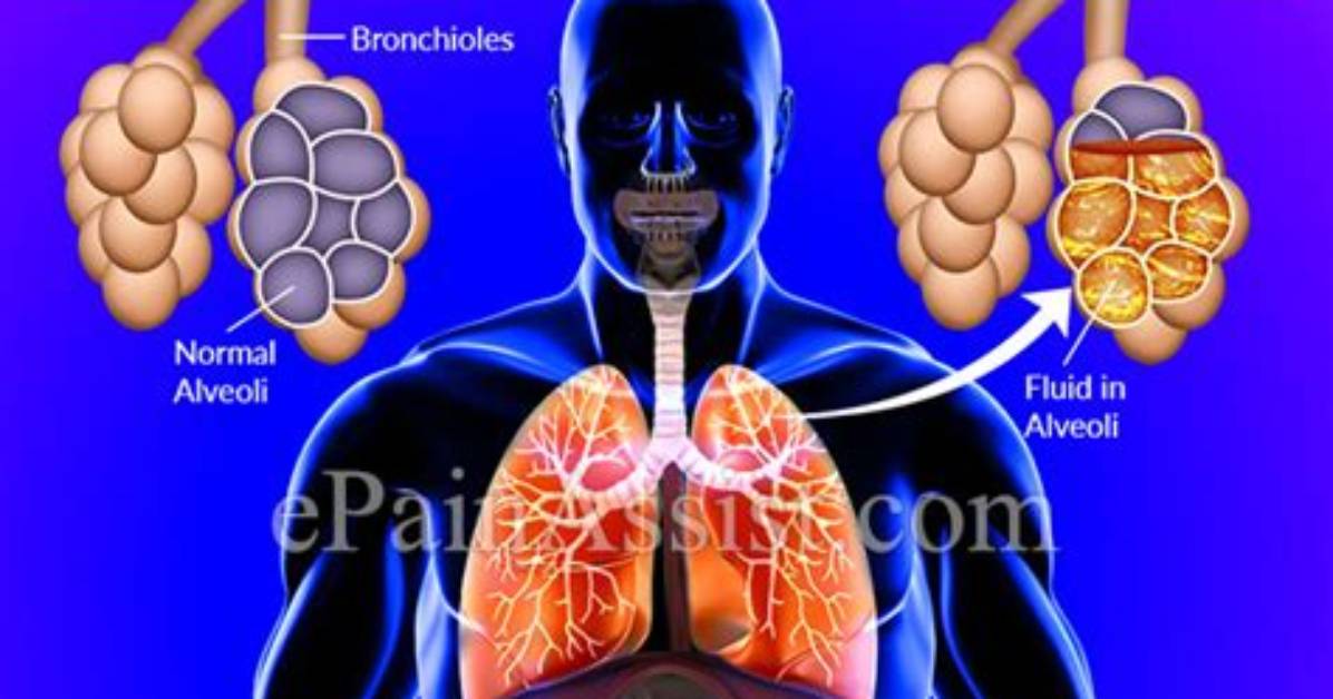 How Long Does It Take for Pneumonia to Go Away?