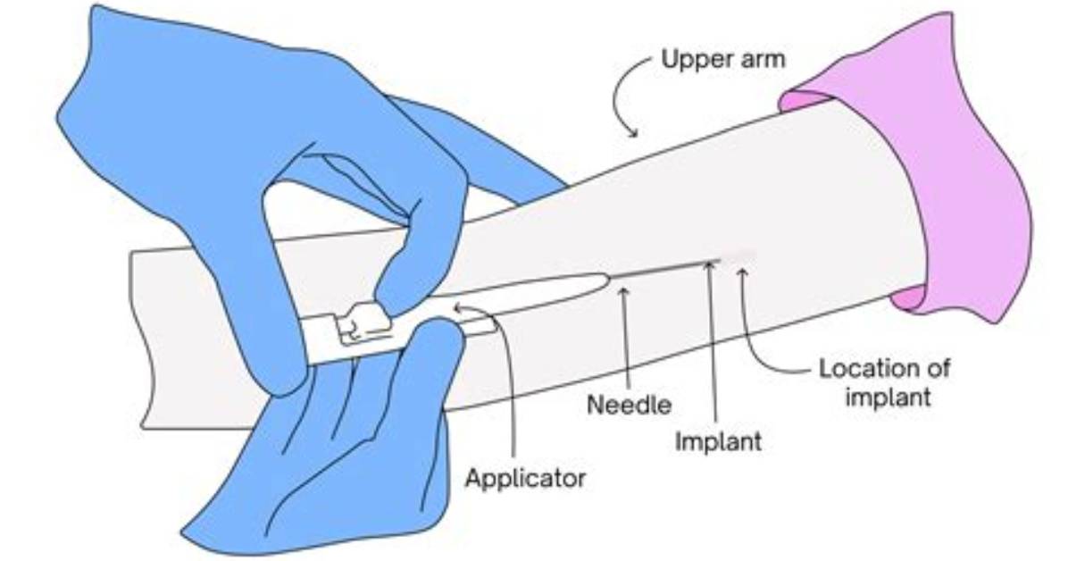 How Long Does Nexplanon Last